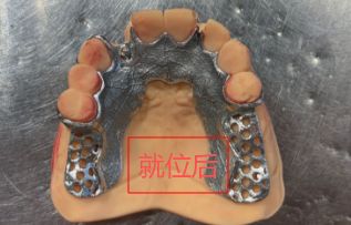 11260283129058 可摘局部义齿支架 设计问题描述图一（PSE 片面记录卡）