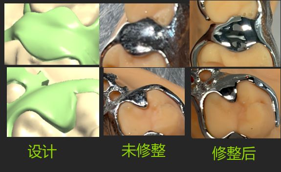 1126072926337-01 可摘局部义齿支架 设计问题描述图二（PSE 片面记录卡）