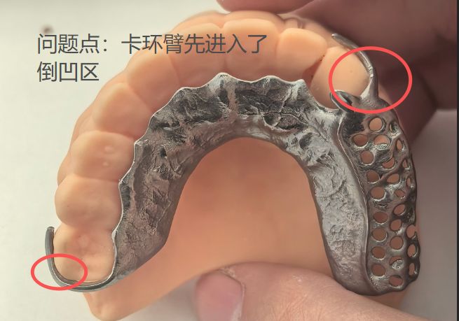 1126073036359-01 可摘局部义齿支架 设计问题描述图一（PSE 片面记录卡）