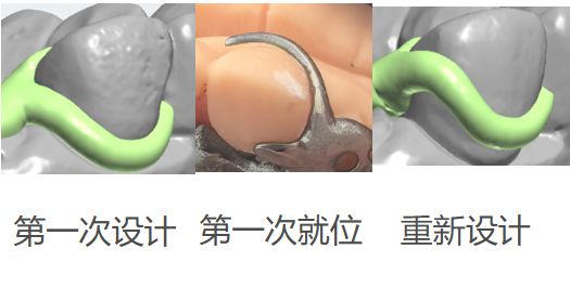 1126073036359-01 可摘局部义齿支架 设计问题描述图二（PSE 片面记录卡）