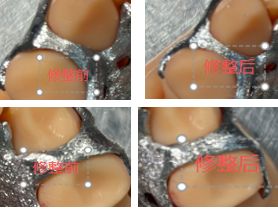 1126081958030 可摘局部义齿支架 设计问题描述图一（PSE 片面记录卡）