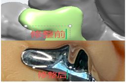 1126082458422 可摘局部义齿支架 设计问题描述图一（PSE 片面记录卡）