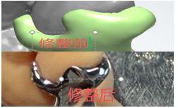 1126082458422 可摘局部义齿支架 设计问题描述图二（PSE 片面记录卡）
