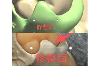 1126082488414 可摘局部义齿支架 设计问题描述图一（PSE 片面记录卡）