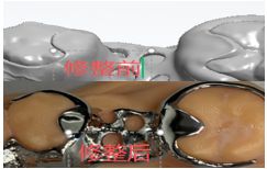 1126082558604 可摘局部义齿支架 设计问题描述图二（PSE 片面记录卡）