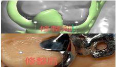 1126082668734 可摘局部义齿支架 设计问题描述图一（PSE 片面记录卡）