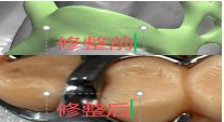 1126082668734 可摘局部义齿支架 设计问题描述图二（PSE 片面记录卡）