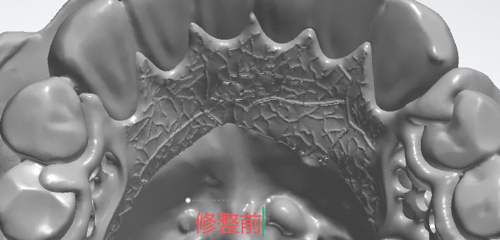 1126082768816 可摘局部义齿支架 设计问题描述图一（PSE 片面记录卡）