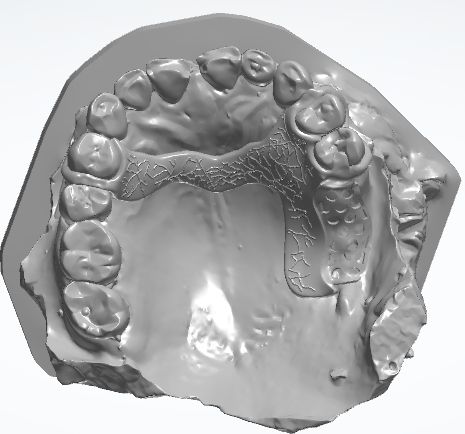 1126083119062 可摘局部义齿支架 戴牙后模型照片（PSE 片面记录卡）