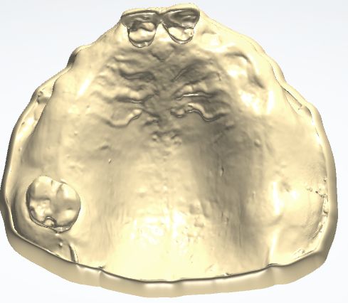 1126090929920 可摘局部义齿支架 原模型照片（PSE 片面记录卡）