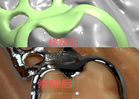 1126091120086 可摘局部义齿支架 设计问题描述图二（PSE 片面记录卡）