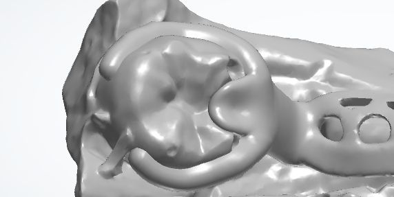 1126092011010 可摘局部义齿支架 设计问题描述图二（PSE 片面记录卡）