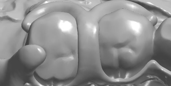 1126092021006 可摘局部义齿支架 设计问题描述图一（PSE 片面记录卡）