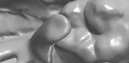 1126092021006 可摘局部义齿支架 设计问题描述图二（PSE 片面记录卡）