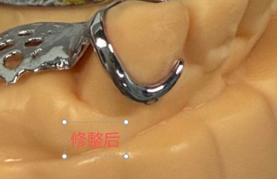 11269082038184 可摘局部义齿支架 设计问题描述图二（PSE 片面记录卡）