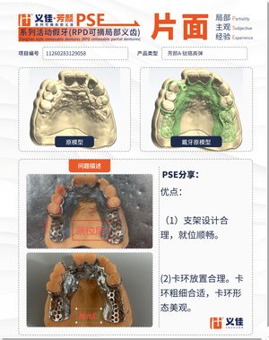 11260283129058 可摘局部义齿支架 PSE 片面记录卡案例