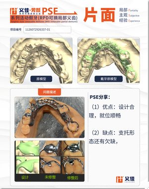 1126072926337-01 可摘局部义齿支架 PSE 片面记录卡案例