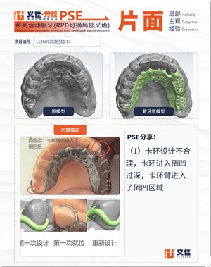 1126073036359-01 可摘局部义齿支架 PSE 片面记录卡案例