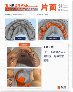 1126080326611-01 可摘局部义齿支架 PSE 片面记录卡案例