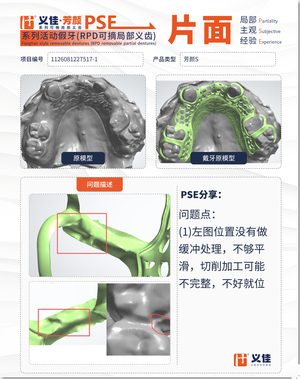 1126081227517-1 可摘局部义齿支架 PSE 片面记录卡案例