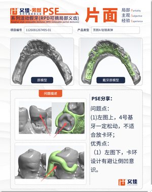1126081267495-01 可摘局部义齿支架 PSE 片面记录卡案例