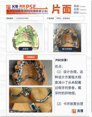 1126081847895 可摘局部义齿支架 PSE 片面记录卡案例
