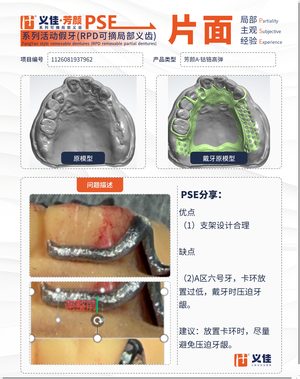 1126081937962 可摘局部义齿支架 PSE 片面记录卡案例