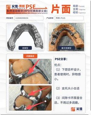 1126082008154 可摘局部义齿支架 PSE 片面记录卡案例