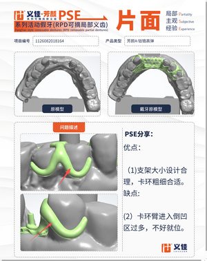 1126082018164 可摘局部义齿支架 PSE 片面记录卡案例