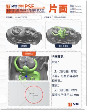 1126082518502 可摘局部义齿支架 PSE 片面记录卡案例