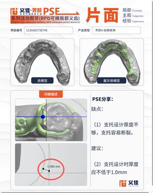 1126082738748 可摘局部义齿支架 PSE 片面记录卡案例