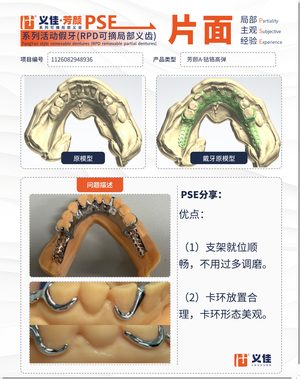 1126082948936 可摘局部义齿支架 PSE 片面记录卡案例