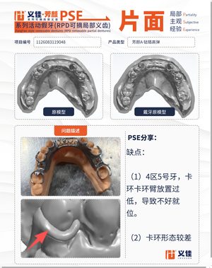 1126083119048 可摘局部义齿支架 PSE 片面记录卡案例