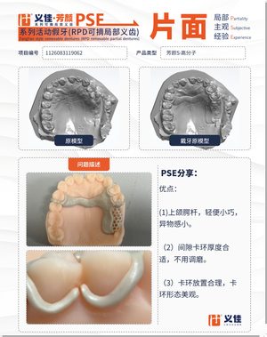 1126083119062 可摘局部义齿支架 PSE 片面记录卡案例