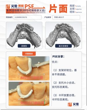 1126090159176 可摘局部义齿支架 PSE 片面记录卡案例