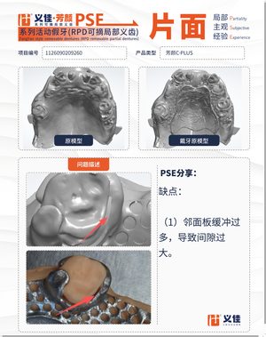 1126090209260 可摘局部义齿支架 PSE 片面记录卡案例