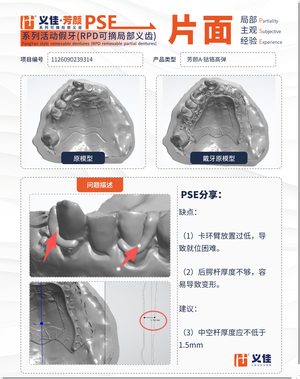 1126090239314 可摘局部义齿支架 PSE 片面记录卡案例