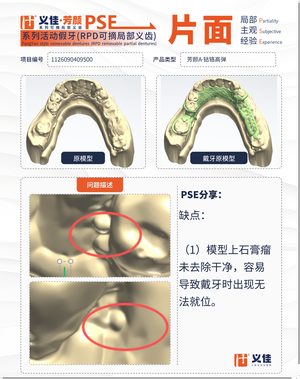 1126090409500 可摘局部义齿支架 PSE 片面记录卡案例