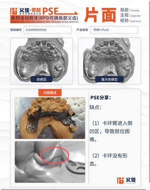 1126090559556 可摘局部义齿支架 PSE 片面记录卡案例