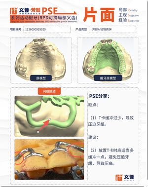 1126090929920 可摘局部义齿支架 PSE 片面记录卡案例