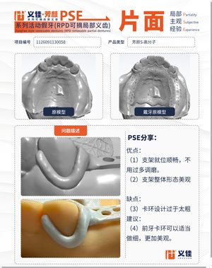 1126091130058 可摘局部义齿支架 PSE 片面记录卡案例