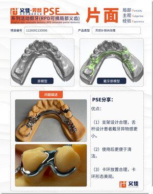 1126091130096 可摘局部义齿支架 PSE 片面记录卡案例