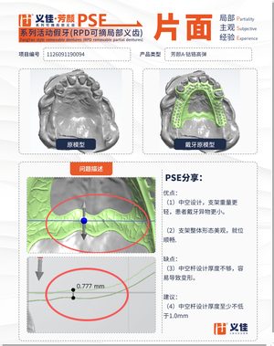 1126091190094 可摘局部义齿支架 PSE 片面记录卡案例