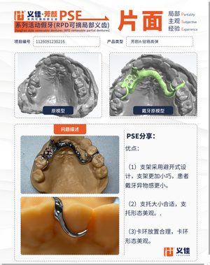 1126091230216 可摘局部义齿支架 PSE 片面记录卡案例