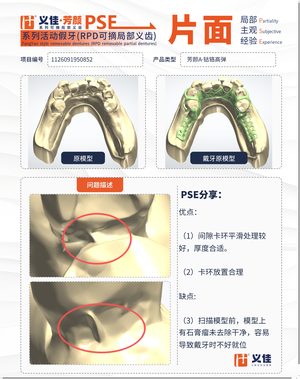 1126091950852 可摘局部义齿支架 PSE 片面记录卡案例