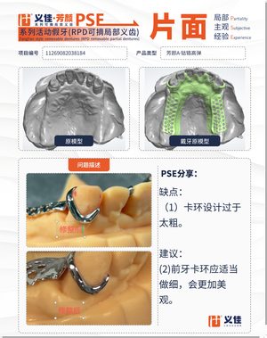 11269082038184 可摘局部义齿支架 PSE 片面记录卡案例