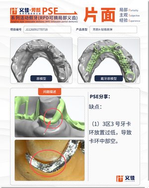 J1126091770718 可摘局部义齿支架 PSE 片面记录卡案例